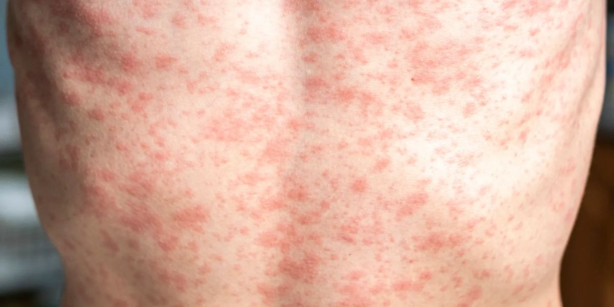 Health Officials warn of Measles Exposure at Rochester Road medical building