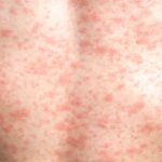 Health Officials warn of Measles Exposure at Rochester Road medical building
