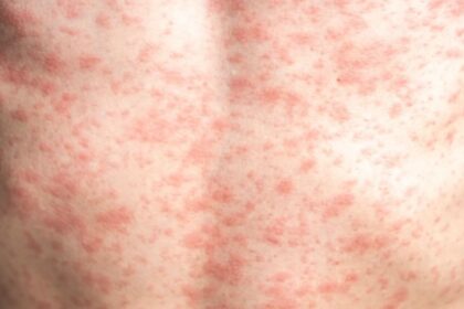 Health Officials warn of Measles Exposure at Rochester Road medical building