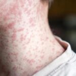 Utah Health officials monitoring possible Measles exposure in Southwestern Region