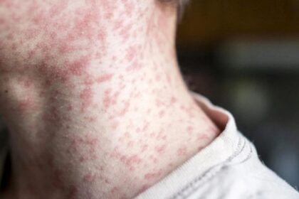 Utah Health officials monitoring possible Measles exposure in Southwestern Region