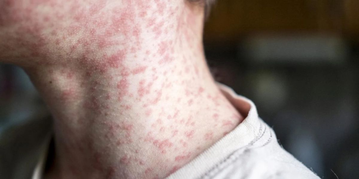 Utah Health officials monitoring possible Measles exposure in Southwestern Region
